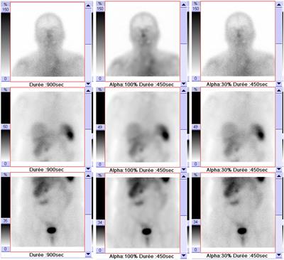 Clinical Validation of a Pixon-Based Reconstruction Method Allowing a Twofold Reduction in Planar Images Time of 111In-Pentetreotide Somatostatin Receptor Scintigraphy